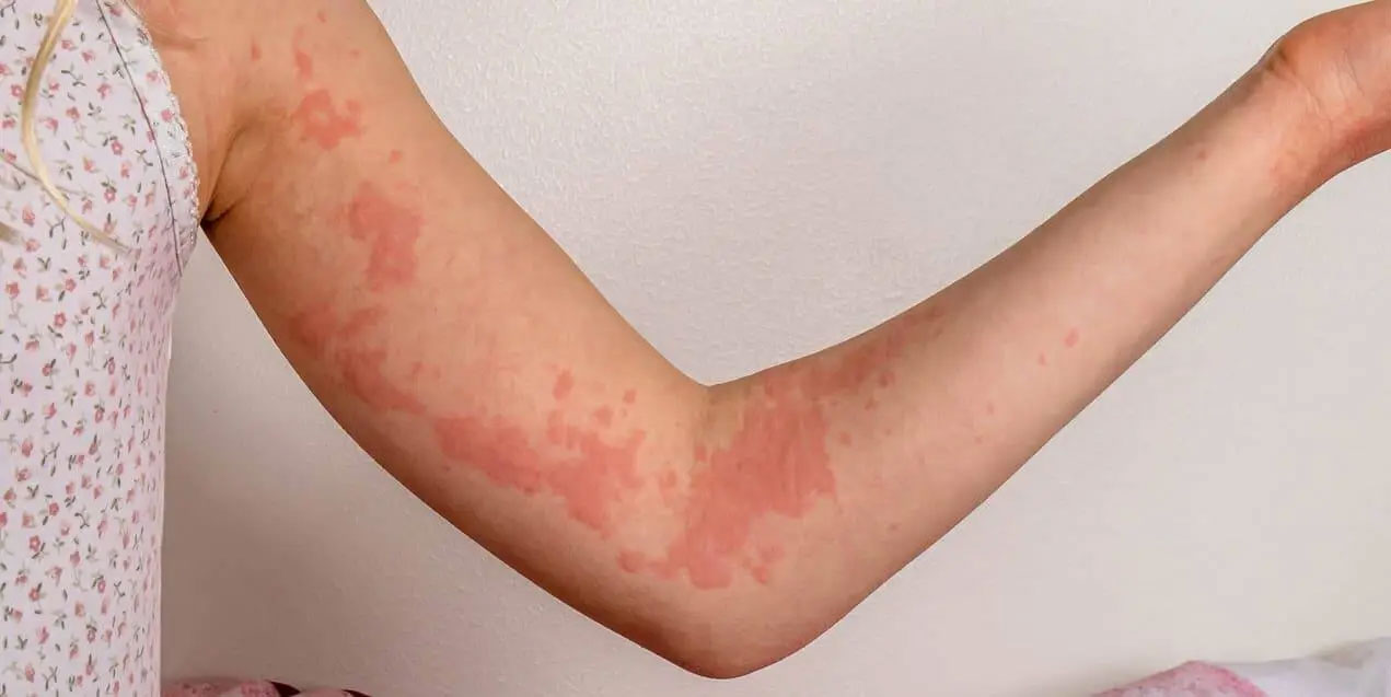 Alcoholism And Skin Problems  The Visible Effects