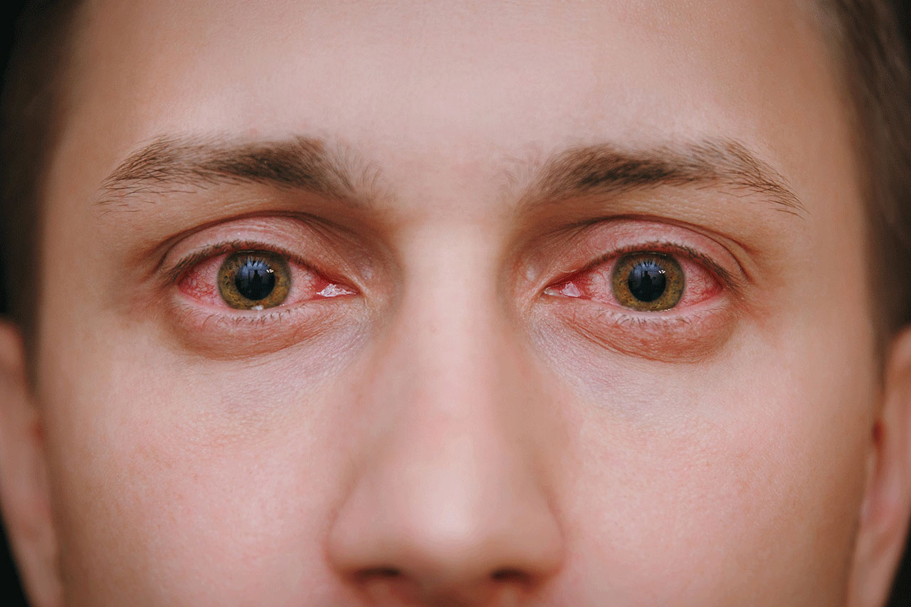 Bloodshot Or Glassy Eyes