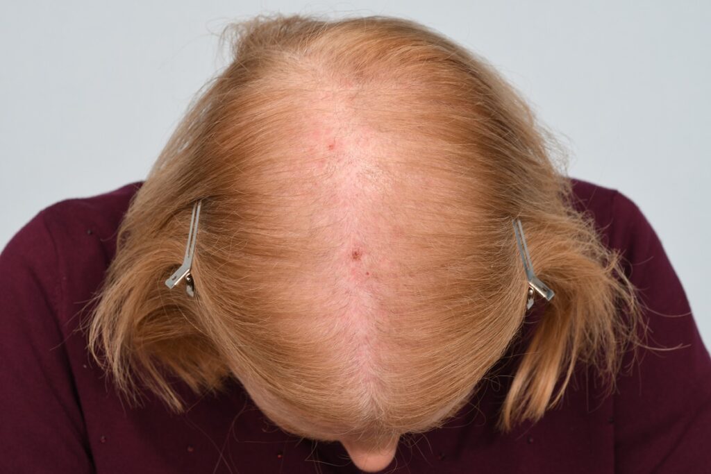 Can Adderall Cause Hair Loss