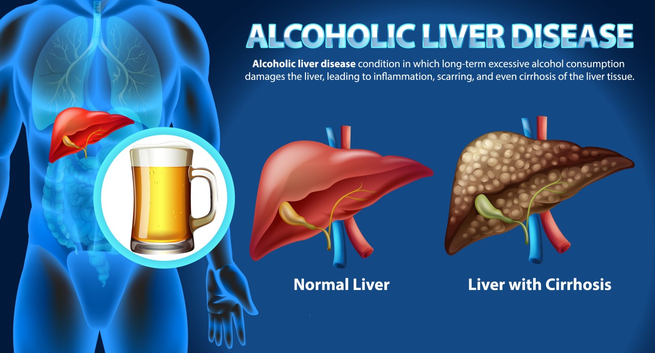 The Impact On Liver Health Beyond Cirrhosis