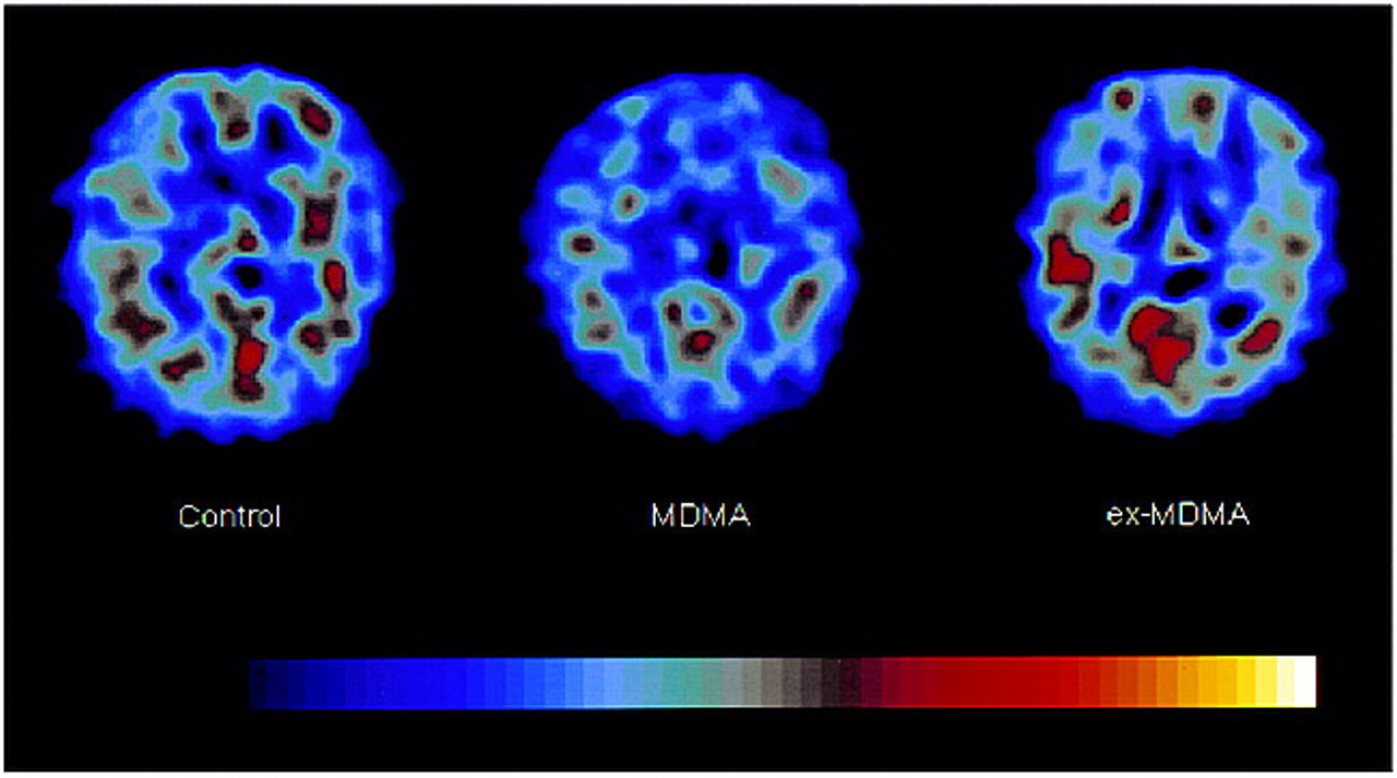 1767668612017_Can 20MDMA 20Cause 20Hematoma